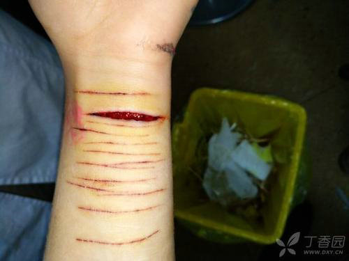 被性侵就割腕 台一15岁少女手腕已留37道刀疤